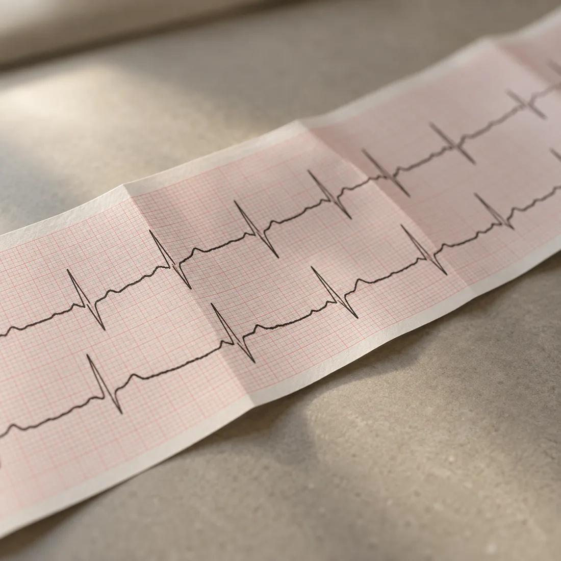 EKG